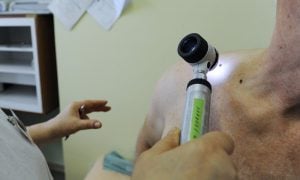 Vyšetrenie znamienok dermatoskopom
