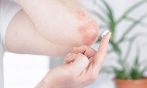 biologická liečba psoriázy