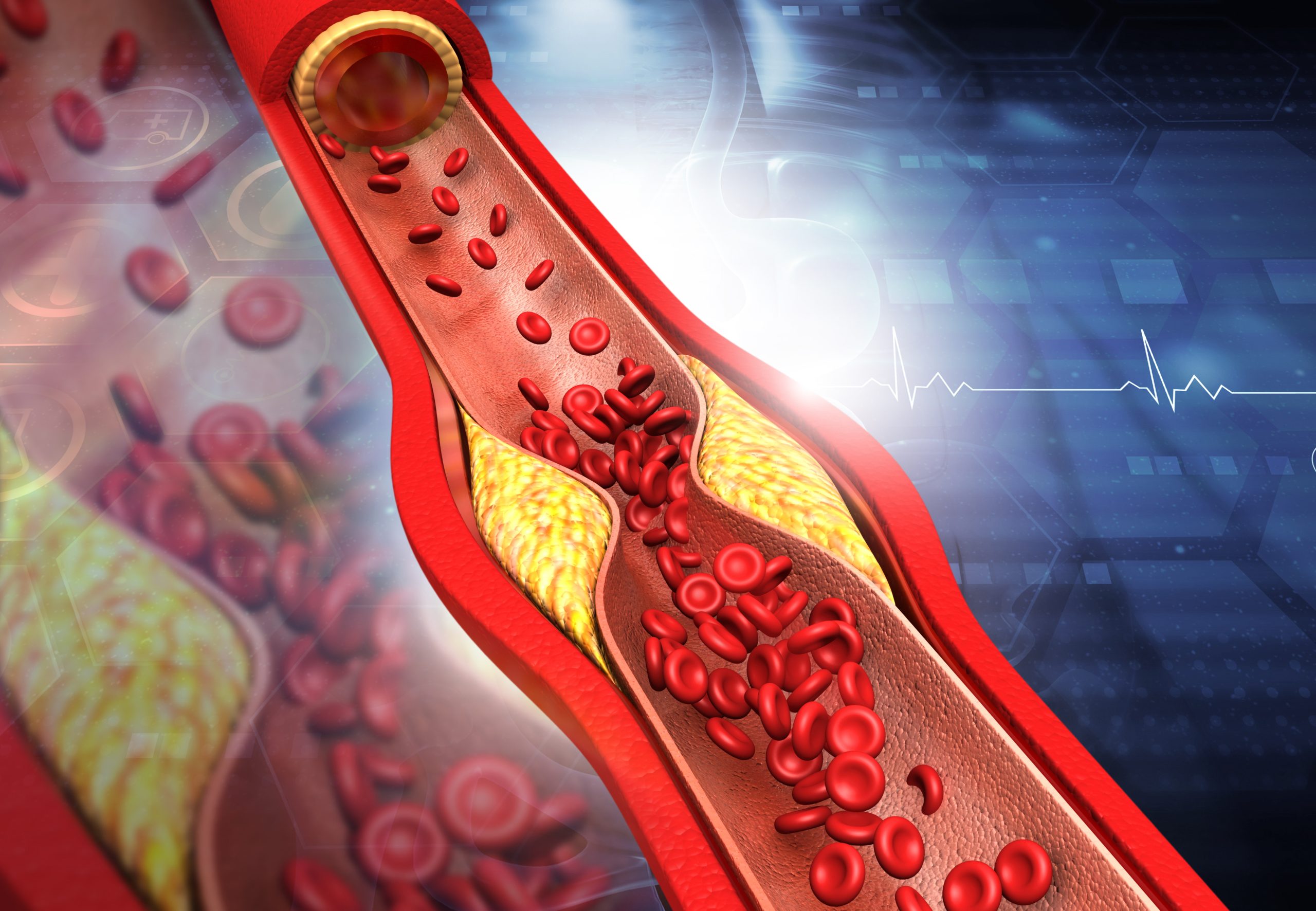Takto mení „zlý“ LDL cholesterol tepnu pri ateroskleróze: Výsledkom môže byť infarkt či mŕtvica