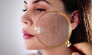 Rosacea
