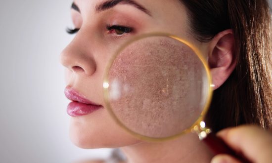 Rosacea