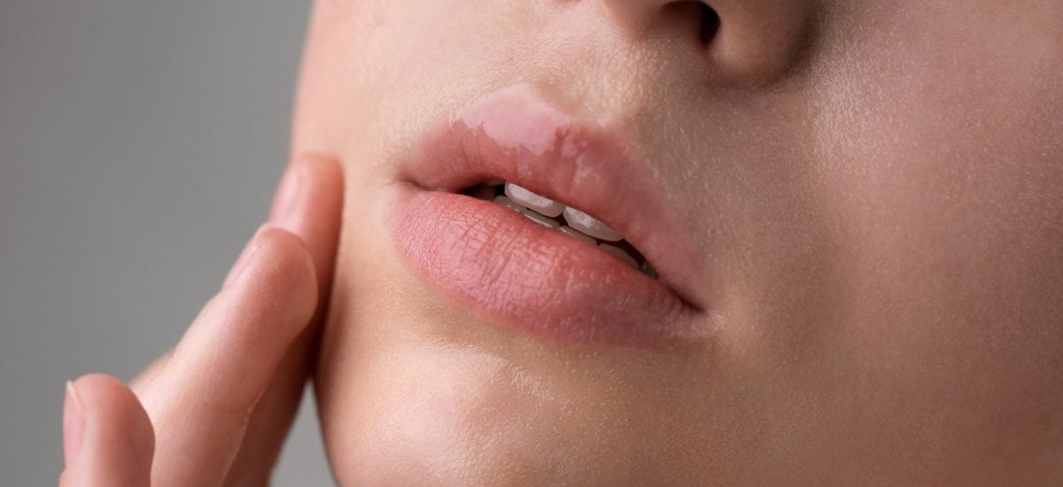 mladá žena lieči boľavý herpes na perách